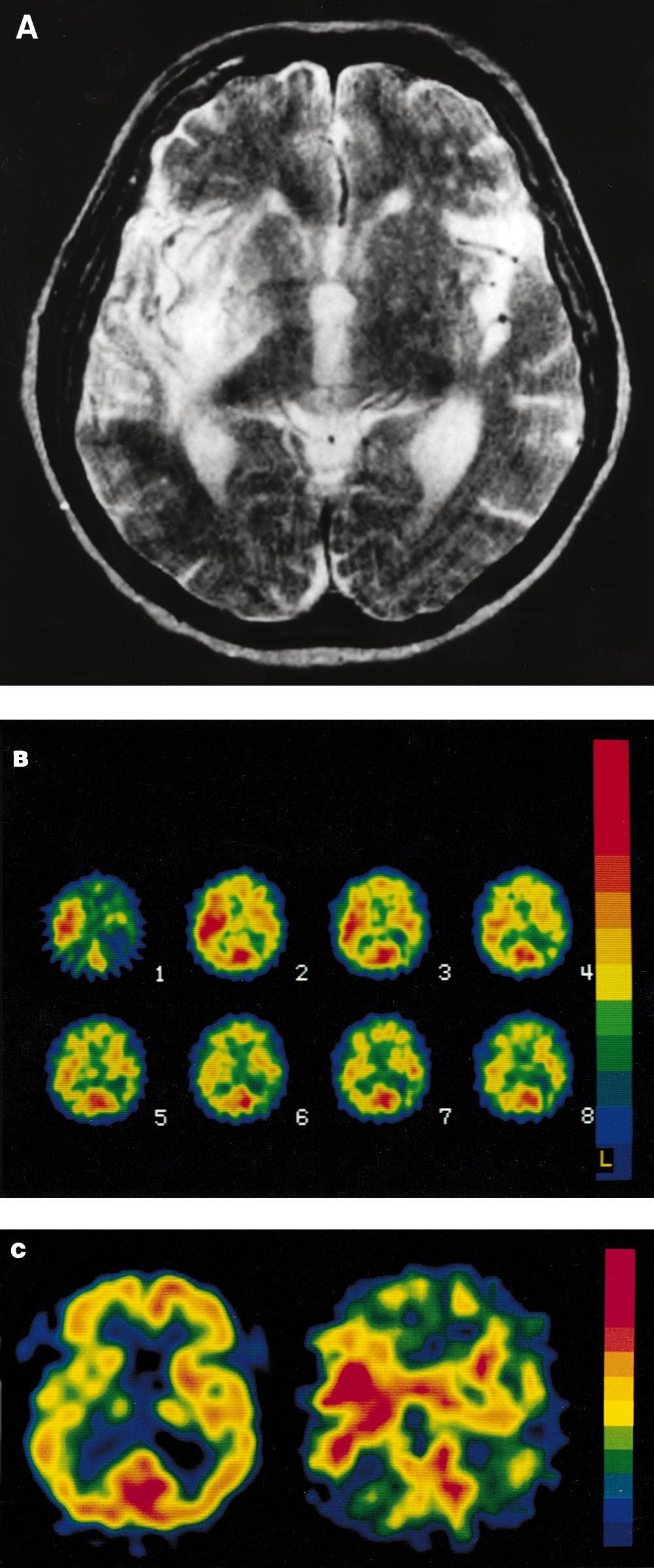 FIGURE 2. Patient 24. (A) T2-weighted MR image obtained 7 d after onset of initial symptoms reveals infarction in right MCA territory.