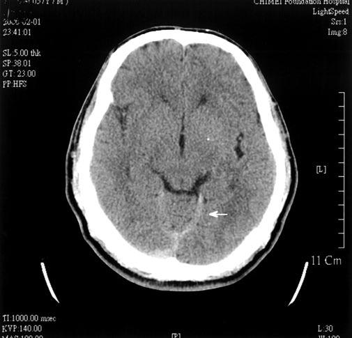 156 J Emerg Crit Care Med. Vol. 19, No. 4, 2008 Fig. 1 Brain computed tomography showing subarachnoid hemorrhage (arrow) Fig.
