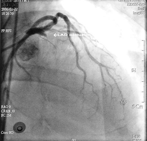 Concurrent subarachnoid hemorrhage and AMI 157 Fig. 3 Coronary angiogram showing total occlusion of the left anterior descending (LAD) artery (arrow) Fig.