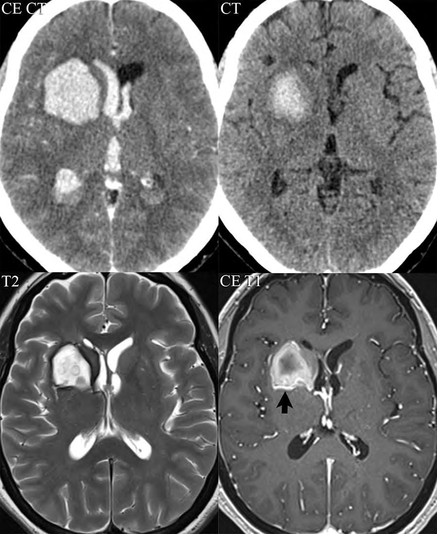 Hypertensive hemorrhage A large acute parenchymal hematoma is seen on the initial CT in this patient (left upper image), with its epicenter in the right putamen.