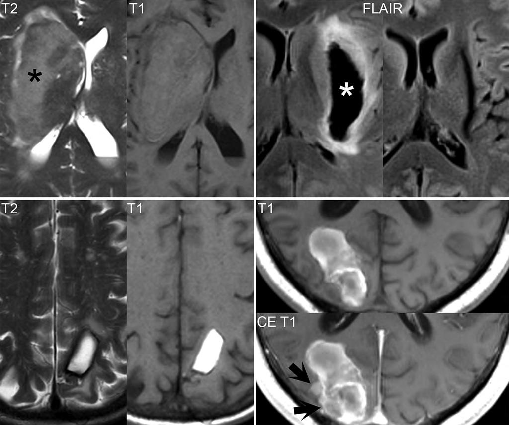 Parenchymal hemorrhage on MR, the spectrum of appearance The third patient illustrates a subacute, extracellular methemoglobin hematoma, with high signal intensity on both T2- and T1- weighted scans,