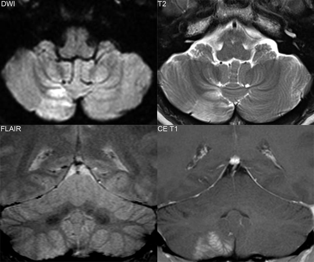 Late subacute, enhancing, PICA infarct There is slight hyperintensity on DWI, which proved to be T2-shine through (not true restricted diffusion) in a portion of the arterial territory of PICA on the