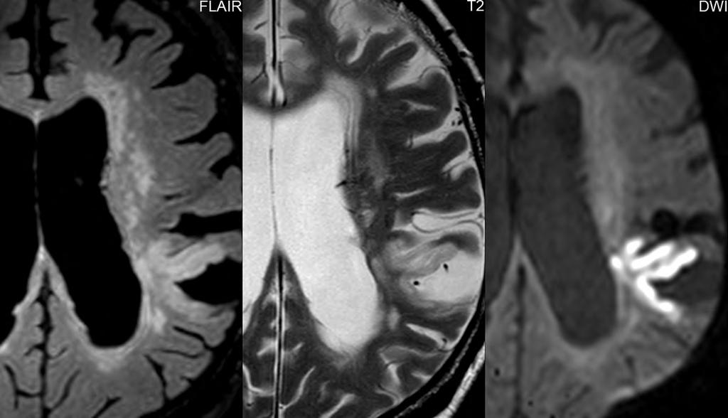 New infarction bordering a chronic infarct The axial FLAIR and FSE T2-weighted scans reveal extensive chronic deep white matter ischemia, together with generalized cortical atrophy and more focal