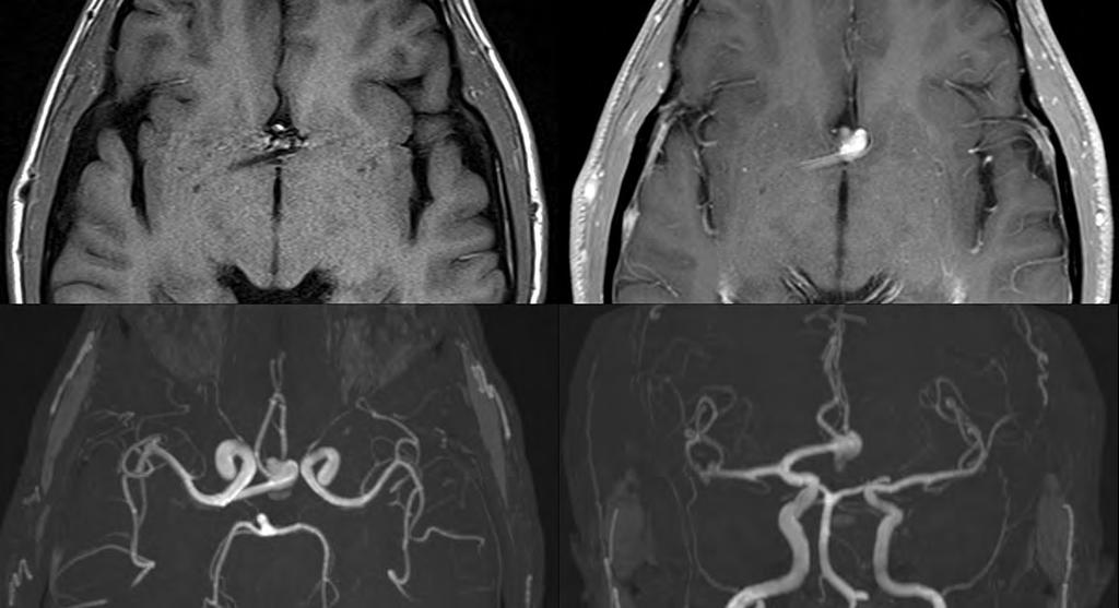 ACA aneurysm Note the prominent pulsation artifact in the first image (a FSE T1-weighted scan at 3 T), seen propagating in the left-right dimension.