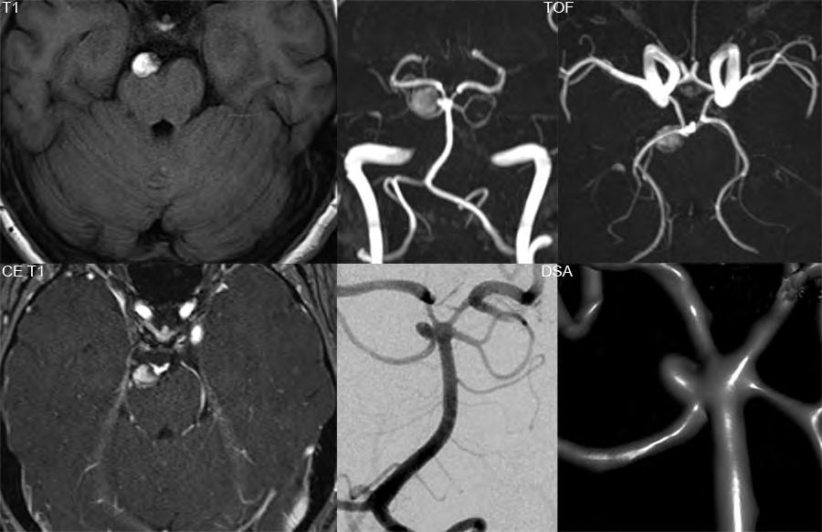 Superior cerebellar artery aneurysm A predominantly hyperintense lesion is noted on the right, anterior to the pons, causing mild adjacent deformity.
