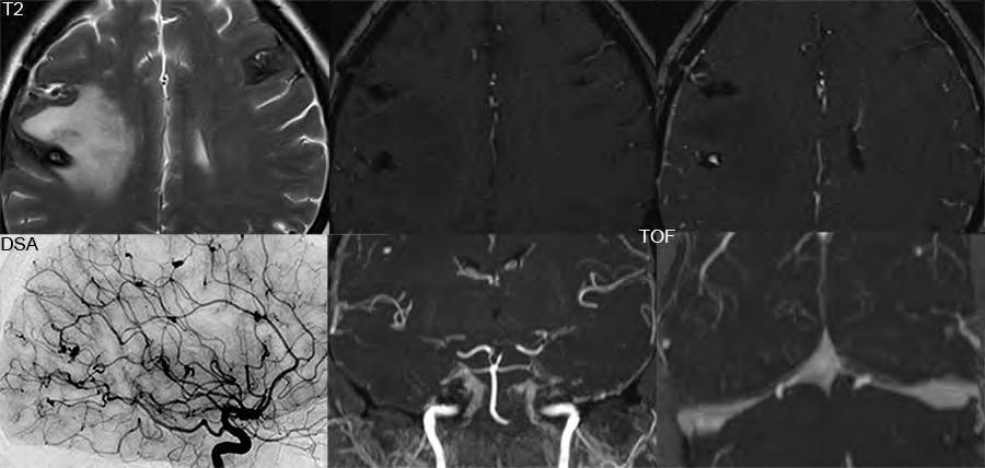 Multiple cerebral aneurysms Several small lesions with peripheral hemosiderin are noted on the axial T2- weighted scan, one with marked associated vasogenic edema.