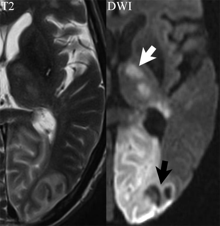 PCA infarction, early subacute There is both vasogenic edema and cytotoxic edema, as demonstrated by respectively high signal intensity on the T2- and the diffusion-weighted scans, in the entirety of