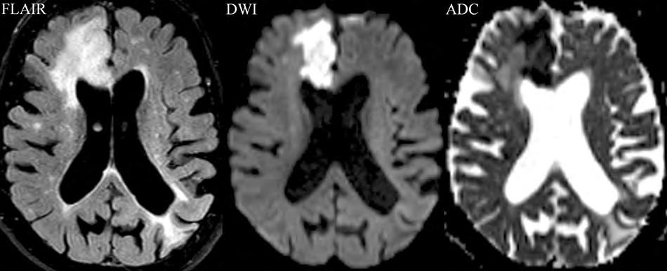 ACA infarction, early subacute On FLAIR, there is abnormal high signal intensity in the medial frontal lobe (ACA territory) on the right, involving both gray and white matter, with mild mass effect