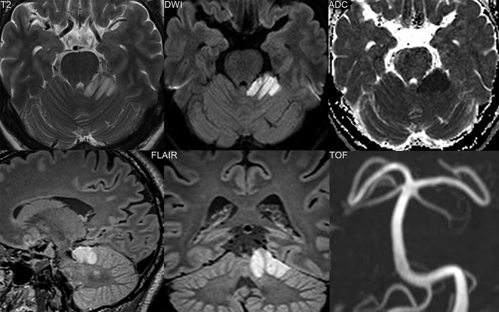 A portion of the superior cerebellar artery territory is noted to be involved on the left, with abnormal high signal intensity on both T2- and diffusion weighted scans.