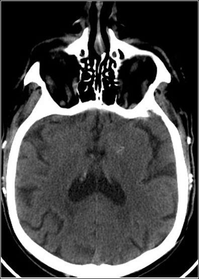 Yannes et al. 11 Figure 1. Non-contrast head CT scan on admission; no evidence of infarction or hemorrhage noted.