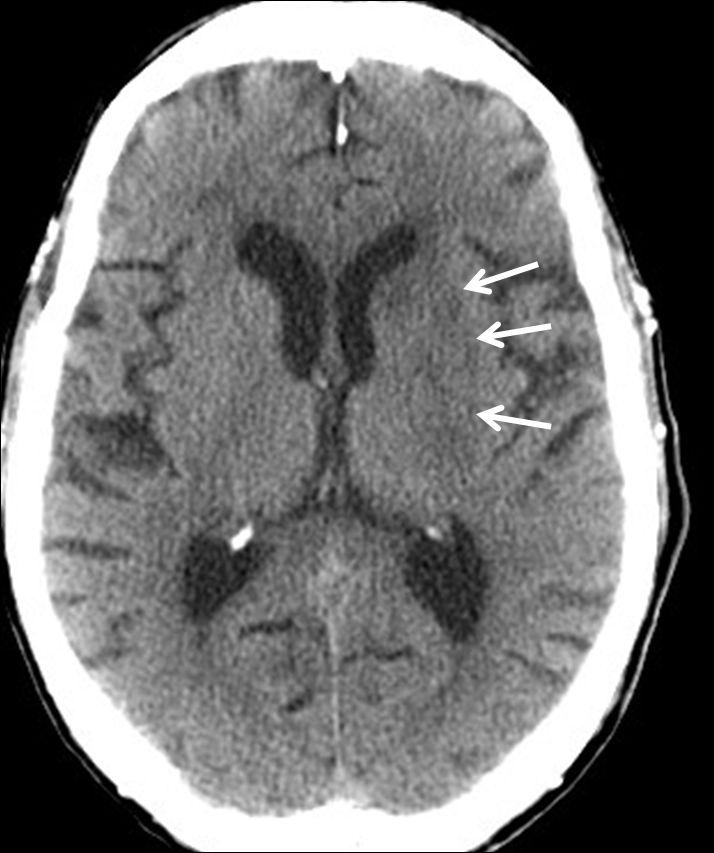 Yannes et al. 13 Figure 3. Non-contrast CT scan of the head (day 9 of hospital stay); demonstrating improvement in the hypodensity noted earlier (arrows). acute ischemic stroke.