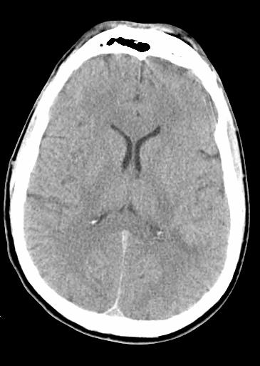 A head CT was therefore first obtained on our patient, K.G.