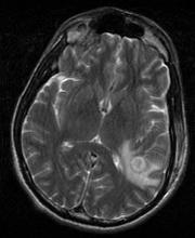 Gadolinium enhanced MRI Ddx Ring Enhancing Lesion MGH digital radiology files Lymphoma Toxoplasmosis Cystercercosis Bartonella TB Listeria Whipple s
