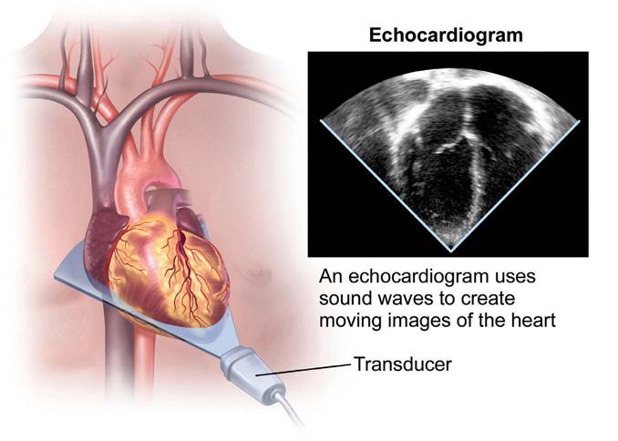 Transthoracic echocardiogram (TTE) This is a standard, non-invasive (no incisions or cuts) echocardiogram that gives your doctor a picture of your beating heart.