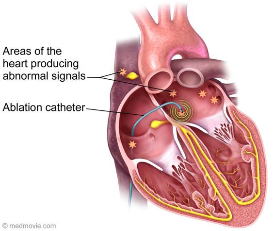 The catheter uses a form of energy to inactivate the tissue and prevent further abnormal signals from being generated. Once the ablation has been completed, the catheter is removed.