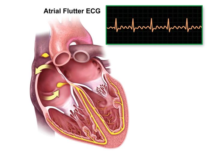 AFL is a heart rhythm disorder that is similar to the more common AF. In AF, the heart beats fast and in no regular pattern or rhythm. With AFL, the heart beats fast, but in a regular pattern.
