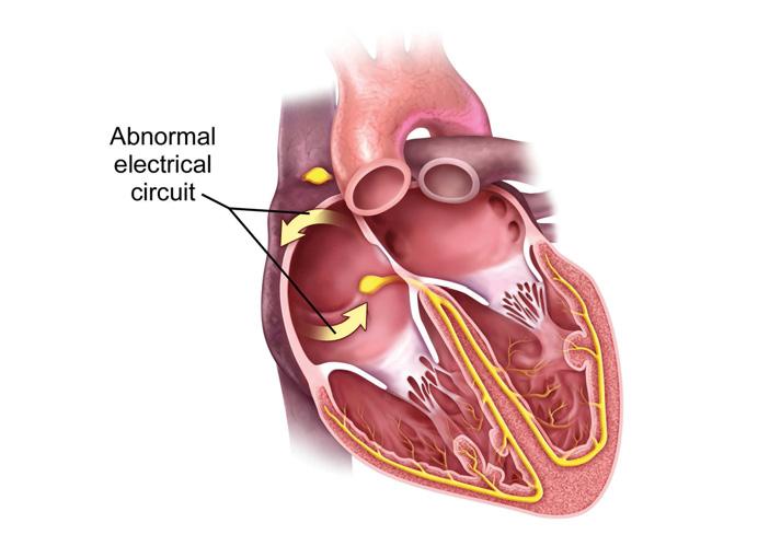 Abnormal electrical circuit within the right atrium Catheter emitting energy to burn the irregular pathway caused by AFL.