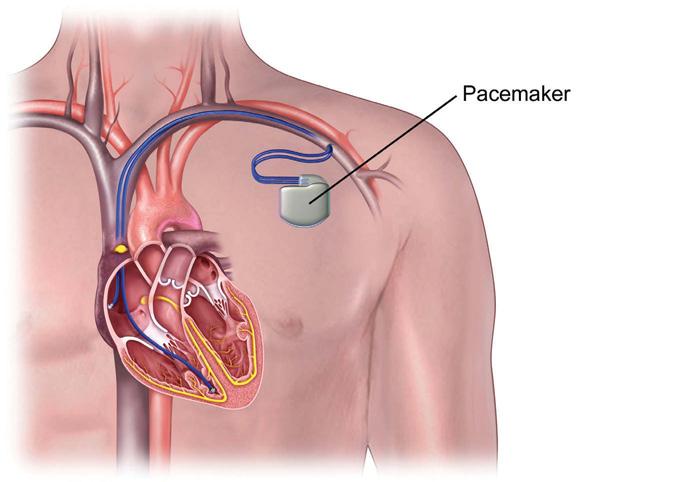 Because the bottom chambers are no longer receiving any electrical signals and therefore cannot pump blood out to the rest of your body, you will need to have a permanent electrical pacemaker