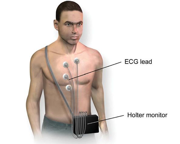 Holter monitor A Holter monitor is a portable ECG. It is typically worn for 24 hours, but can be worn for several days.
