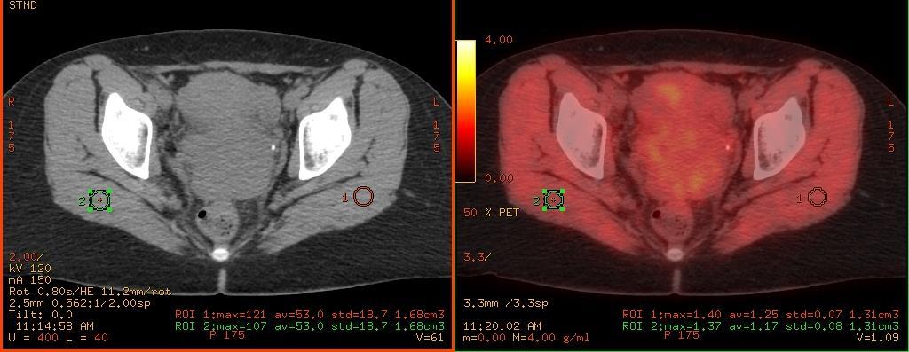 Image Analysis Cervix: non-hypoxic reference (glut max muscle) SUV mean Tumor