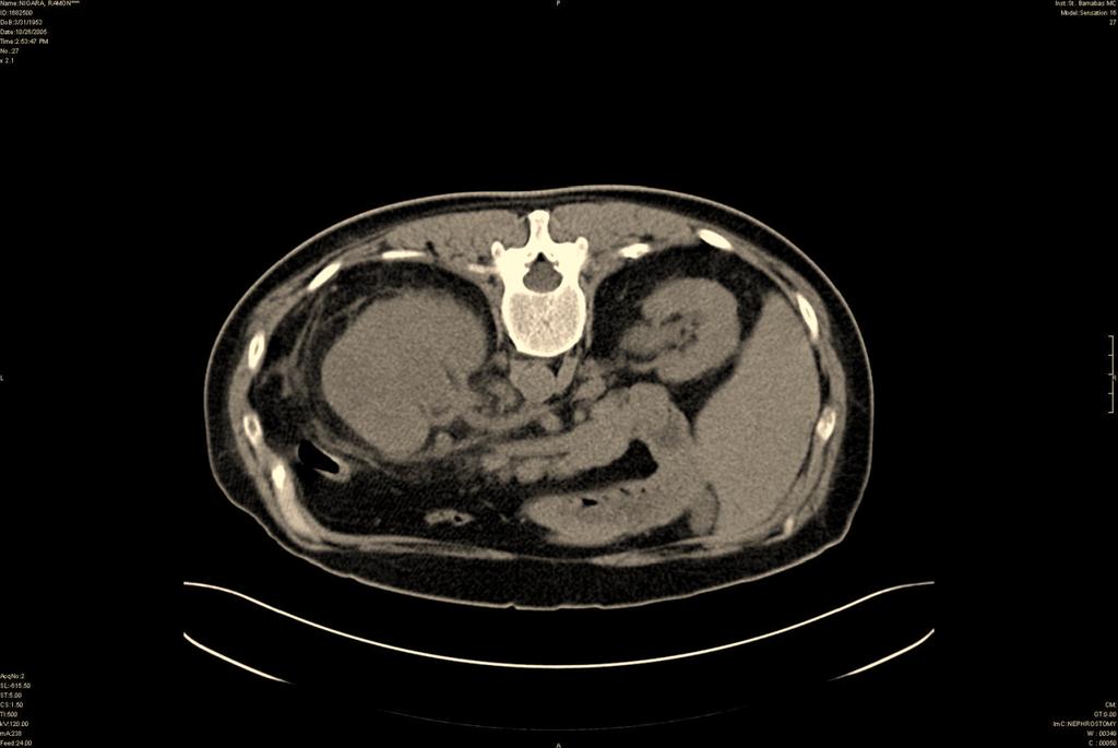 The Open Pathology Journal, 2008, 2, 115-119 115 Open Access High Grade Transitional Cell Carcinoma of the Renal Pelvis with Divergent Differentiation Mimicking a Renal Abscess Navér A.