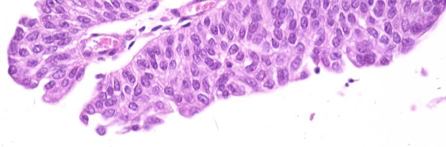 Immunohistochemical stains demonstrated biphasic expression of the sarcomatous component with