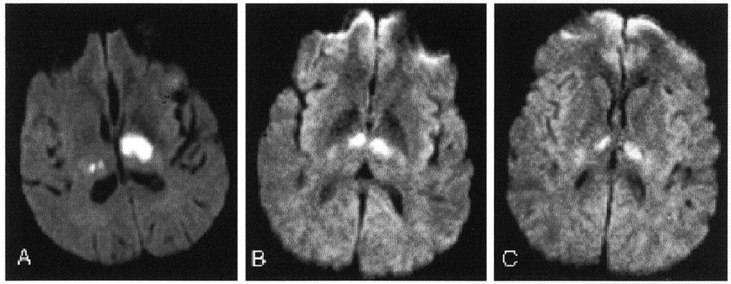 Figure 5. Diffusion-weighted MRI of acute thalamic infarction in 2 patients.