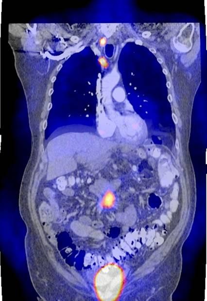 A B C D Chapter 5. Figure 2. Fused 18 F-DOPA PET CT scan (A), SRS (B), 18 F-DOPA PET (C) and 11 C-5-HTP PET (D) of a 80 year old male patient with metastatic carcinoid tumor.