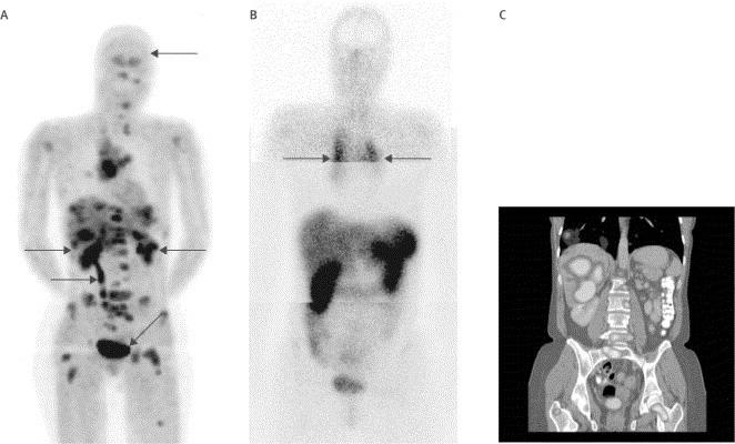 Staging of carcinoid tumours with 18 F-DOPA PET: a prospective, diagnostic accuracy study 18 F-DOPA PET produced high-quality tomographical images that were easily interpretable (figure 2).