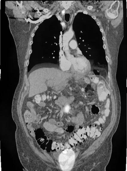 Improved staging and characterization of lesions in patients with carcinoid and islet cell tumors with 18 F-DOPA and 11 C-5-HTP positron emission tomography A B C D Figure 2. Full-color in appendix.