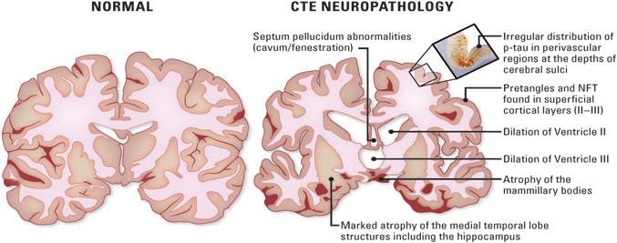 BLAST-RELATED CTE S-29 FIG. 1. Neuropathology of chronic traumatic encephalopathy (CTE). Coronal sections of normal brain (left) and brain with CTE neuropathology (right).