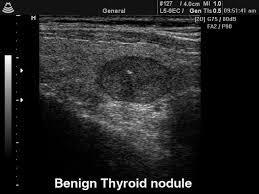 1.2 Thyroid nodule The term thyroid nodule refers to an abnormal growth of thyroid cells that forms a lump within the thyroid gland. A thyroid nodule is shown in the figure 2.
