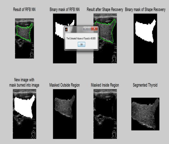 SIMULATION RESULTS Fig 7: Neural network processing OBSERVATION : Then the image is processed in the RBF neural network tool as in the above figure for segmentation and volume estimation.