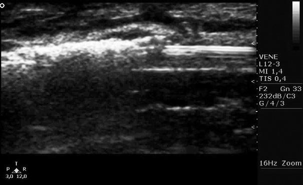 The split screen function shows the small saphenous vein on the right side is not compressible after applying pressure with the transducer. Fig 2.