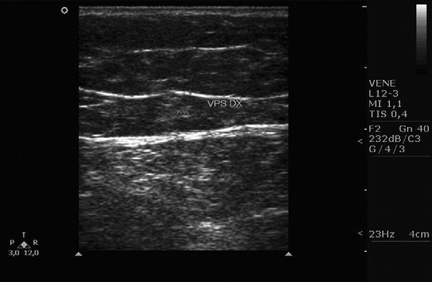 976 Kontothanassis et al JOURNAL OF VASCULAR SURGERY April 2009 Fig 5. At the 1-year follow-up, a trace of the small saphenous vein (arrowheads) is barely noticeable inside the canal.