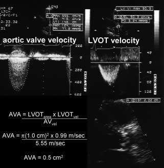 CME Echocardiography Image courtesy of Barbara A. Berko, MD; Alyson N. Owen, MD; Donna R. Zwas, MD Figure 1.