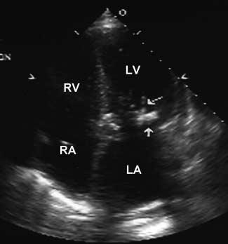 The contractile function of the left atrial appendage can be assessed as can the presence of spontaneous echo contrast, which are associated with a low flow state, and are predictors of thrombus