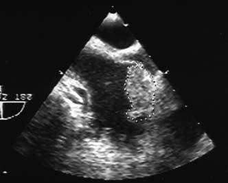 CME Echocardiography Image courtesy of Barbara A. Berko, MD; Alyson N. Owen, MD; Donna R. Zwas, MD Figure 3.