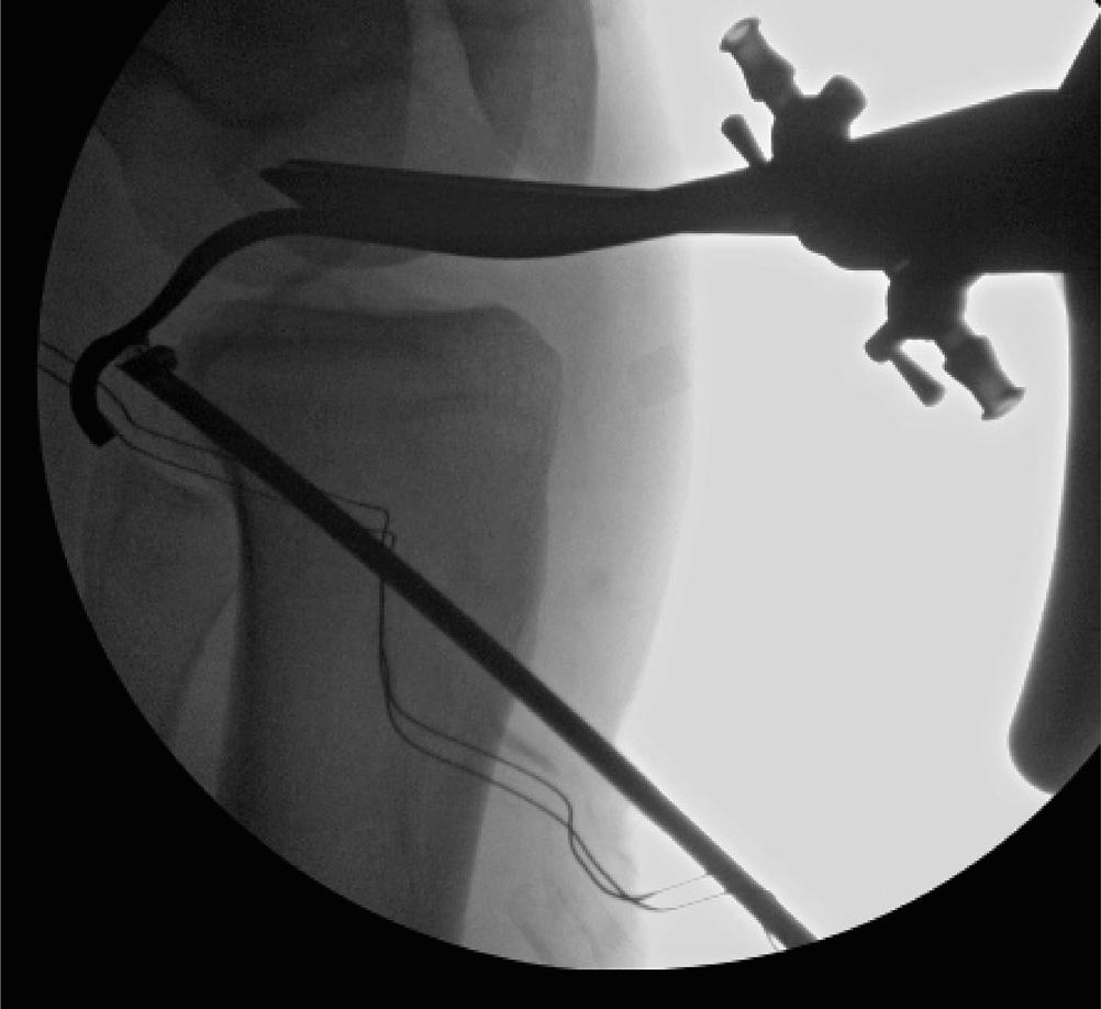 The anterior tibialis had a doubled diameter of 8.5 mm and was 290 mm long. The graft was tripled, and the posts of the graft preparation board were set at 80 mm.