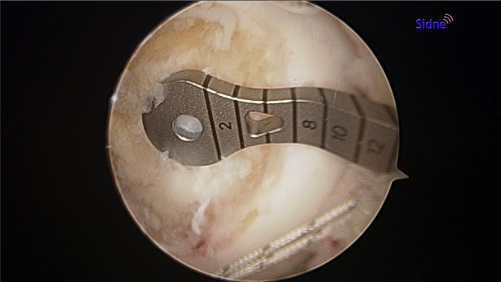GRAFTLINK CONSTRUCT e113 Fig 4. Arthroscopic view of medial femoral condyle in right knee with 30 arthroscope. The PCL guide for the FlipCutter is in the middle of the PCL femoral footprint.