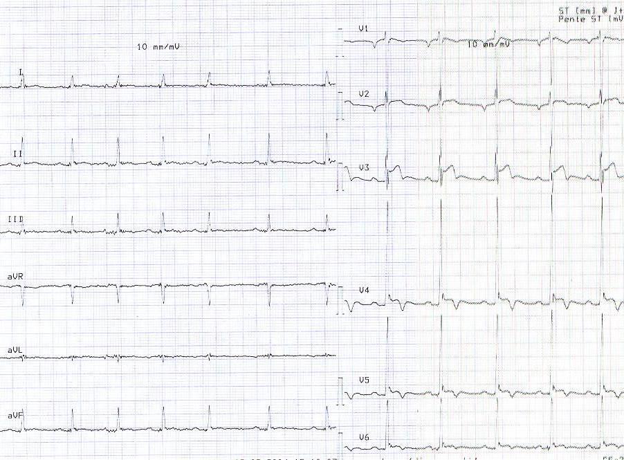 Myocarditis diagnostic (3) ECG signs Resting ECG Sensitive tool Timely repeated Conduction