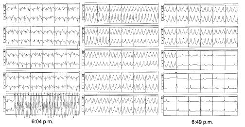 Myocarditis diagnostic (3) ECG signs Holter monitoring Exercise