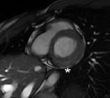 myocarditis (EBV) T2 weighted images Acute myocarditis Spotty epicardial areas