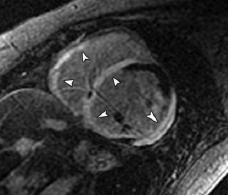 myocarditis scar fibrosis Sparrow Pj RadioGraphics 2009; 29:805 23 Friedrich MG