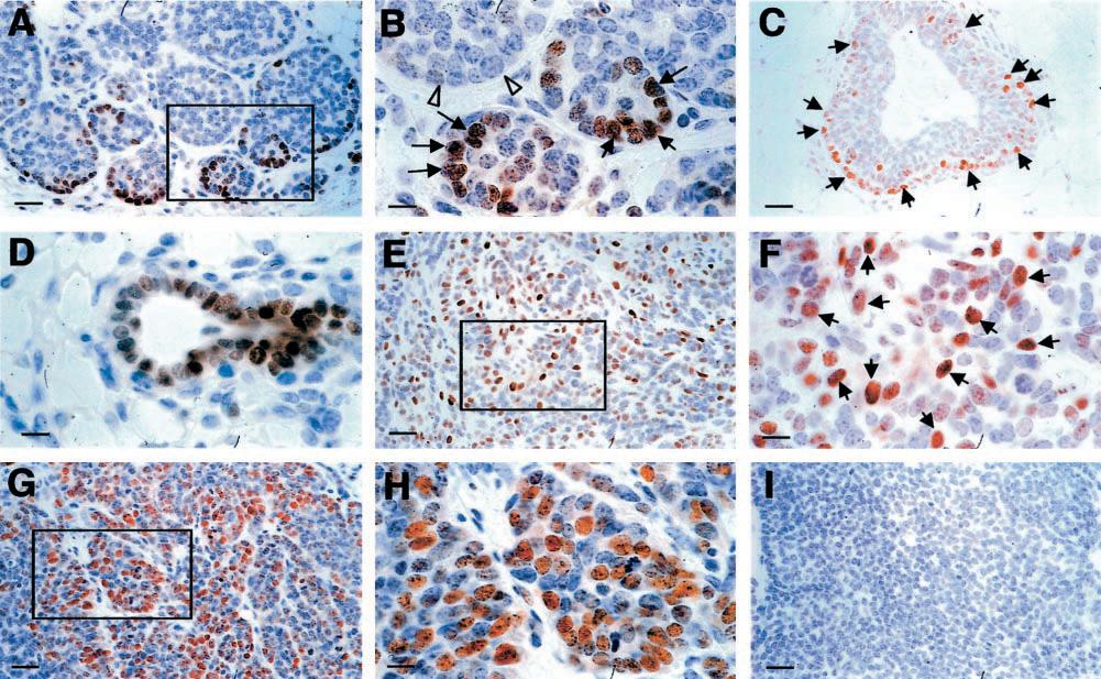 2122 Lin et al Figure 7. Increased expression of cyclin D1 during tumor progression to malignancy.