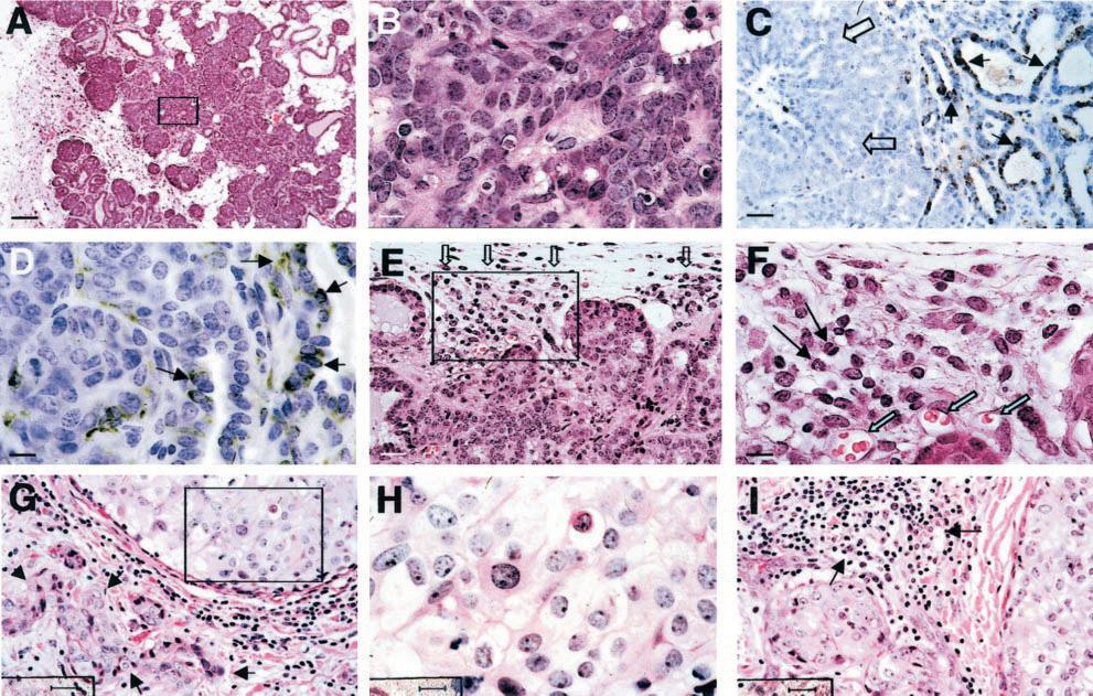 2118 Lin et al Figure 3. Early carcinoma in PyMT mice is comparable to human ductal carcinoma in situ with early invasion (DCIS EI).