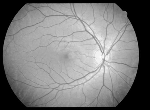 retina & optic nerve Retina forms as an outgrowth of the