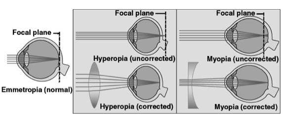 Effects of Corrected Lenses Retinal Cells Posterior layer