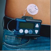 Insulin pump technology Insulin pump models currently available: Animas 2020 Paradigm real-time MMT-522