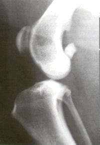 Osteophytes are evident as soon as 1 to 3 weeks after the rupture in some patients.